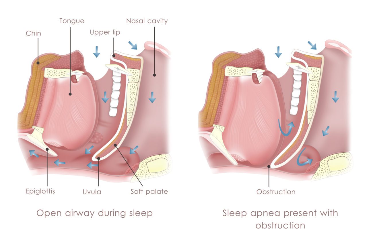 sleep-apnea-claremont-ca-how-to-stop-snoring